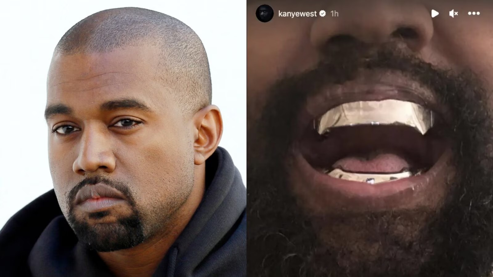 Kanye West nhổ hết răng thật để thay bộ răng Titan có giá “đắt hơn cả kim cương"!